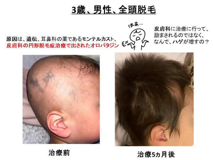 円形脱毛症　病院